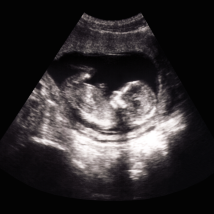 An ultrasound image of a fetus in utero.