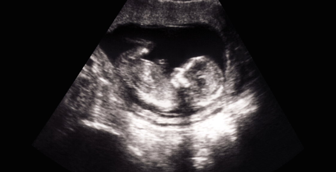An ultrasound image of a fetus in utero.